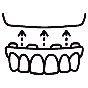 IMPLANT SUPPORTED OVER DENTURE
